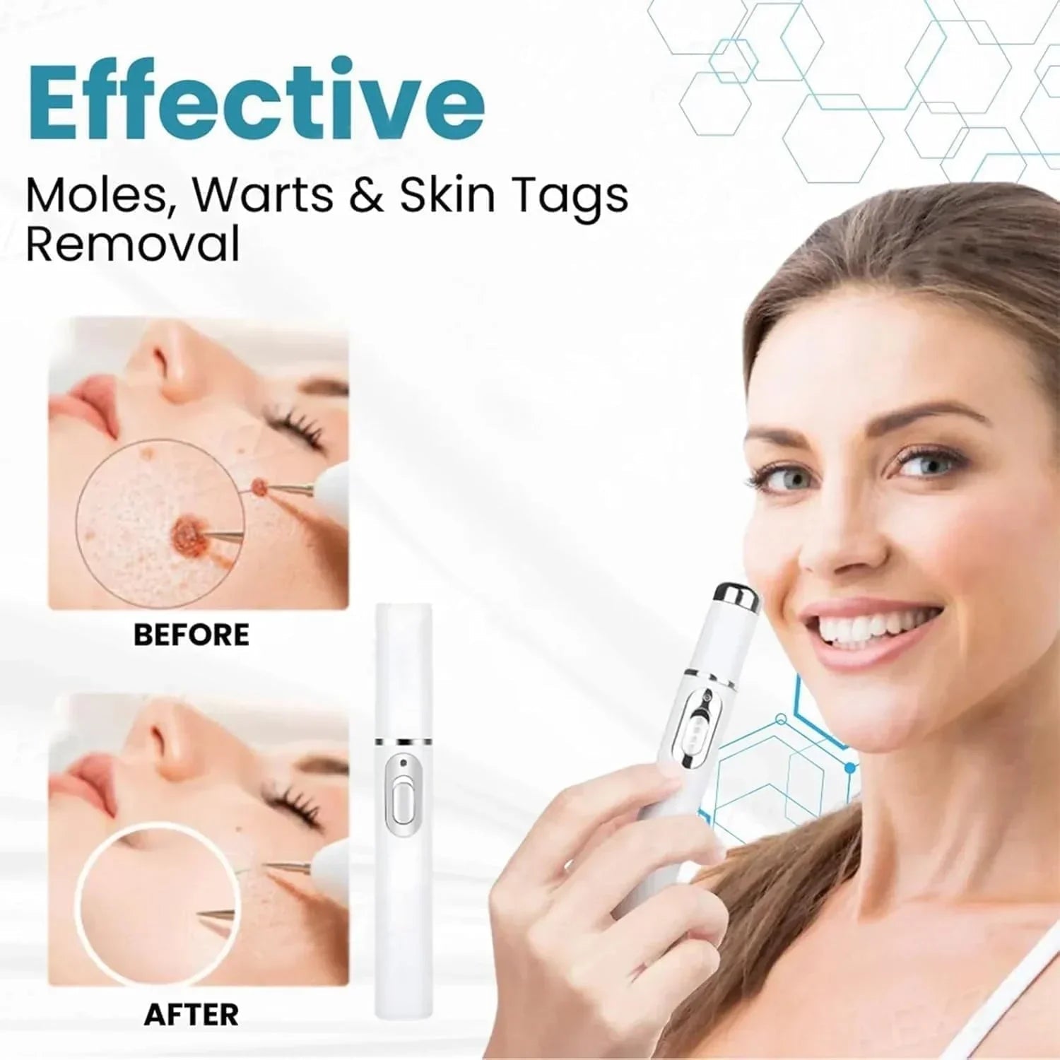 Non - Invasive Mole and Wart Removal Pen - Rumaisas