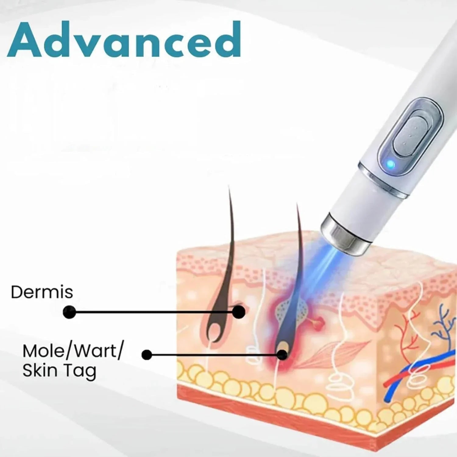 Non - Invasive Mole and Wart Removal Pen - Rumaisas