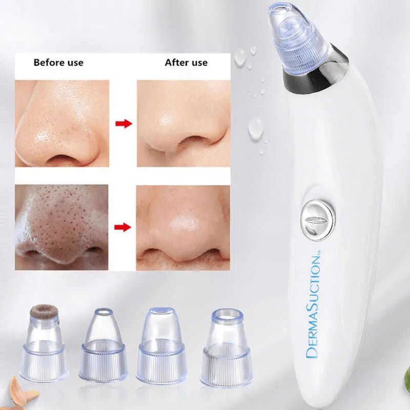 DermaSuction Cell Operated Blackhead Remover with 4 Suction Heads - Rumaisas