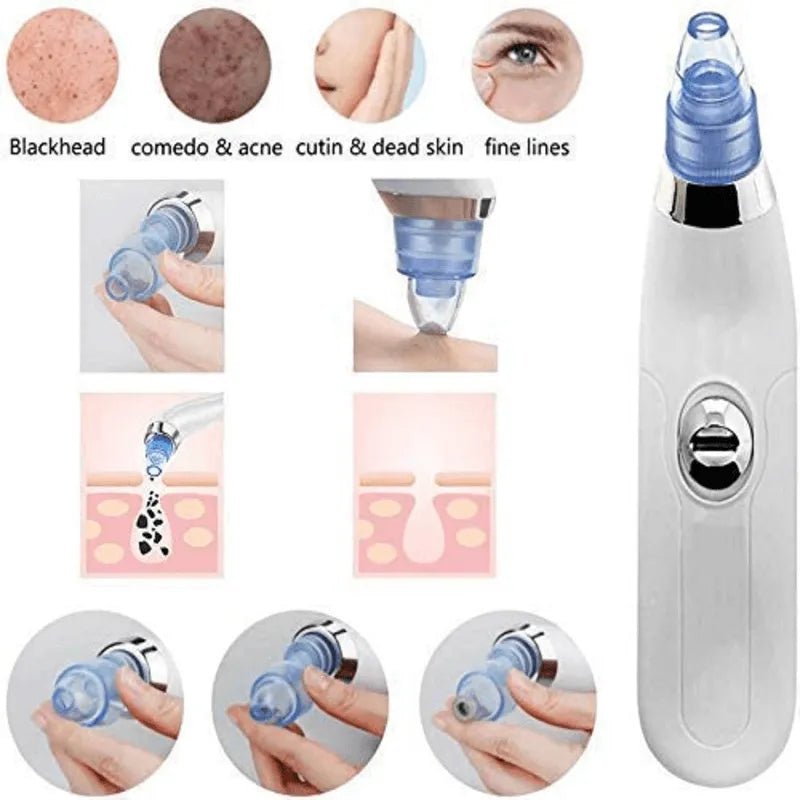 DermaSuction Cell Operated Blackhead Remover with 4 Suction Heads - Rumaisas
