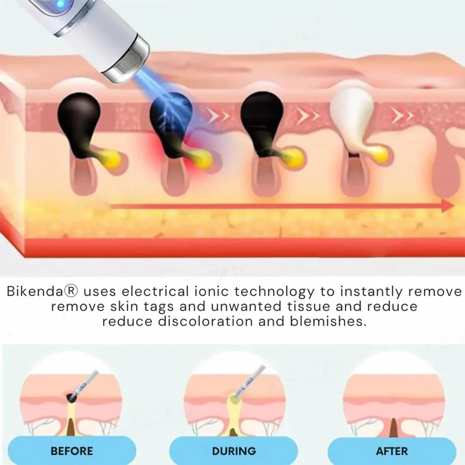 Non - Invasive Mole and Wart Removal Pen - Rumaisas